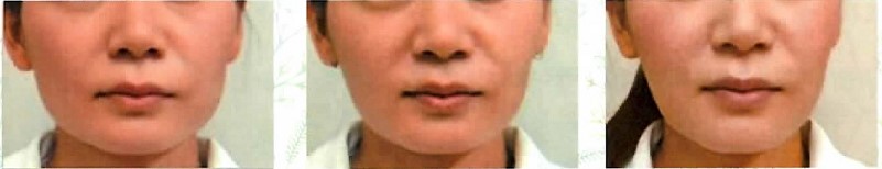 ボトックスの症例写真