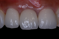 審美的な前歯部インプラント補綴