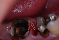 治療前虫歯の状態
