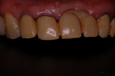 術前の上前歯の写真