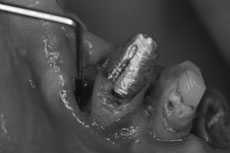 犬歯の骨欠損の状態