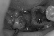 水平埋伏智歯の歯冠が見える状態