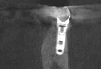 最後臼歯インプラントのCT画像