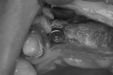 抜歯即時埋入部の状態