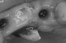 結合組織を歯冠乳頭形成部位に滑り込ませている状態