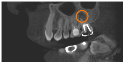 CT画像上顎大臼歯歯根破折矢状面