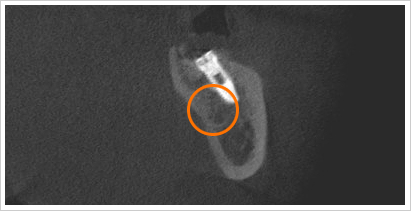 CT画像大臼歯インプラント埋入矢状面