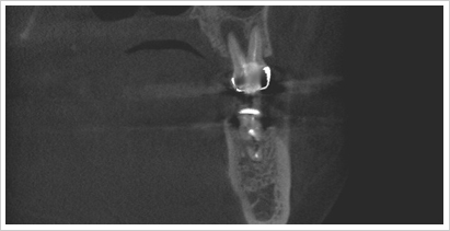 CT画像上顎大臼歯歯根破折前頭面